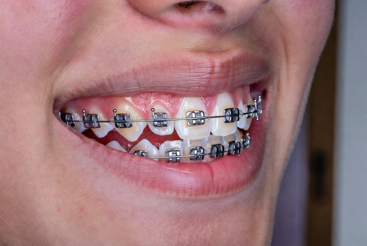 teeth braces in Lahore