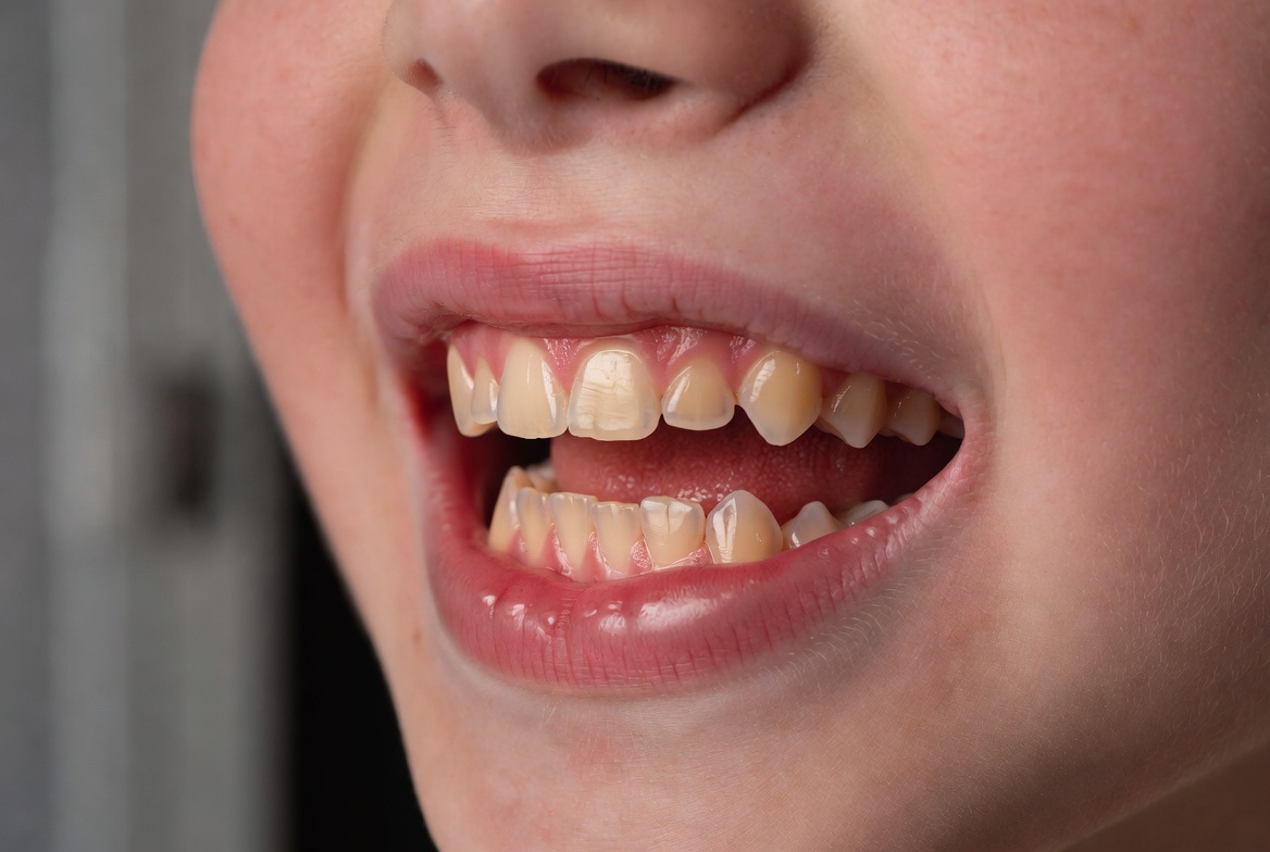 Crooked teeth problem