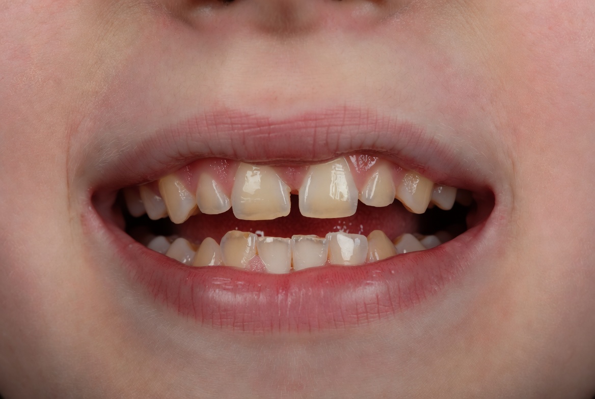 worn teeth problem