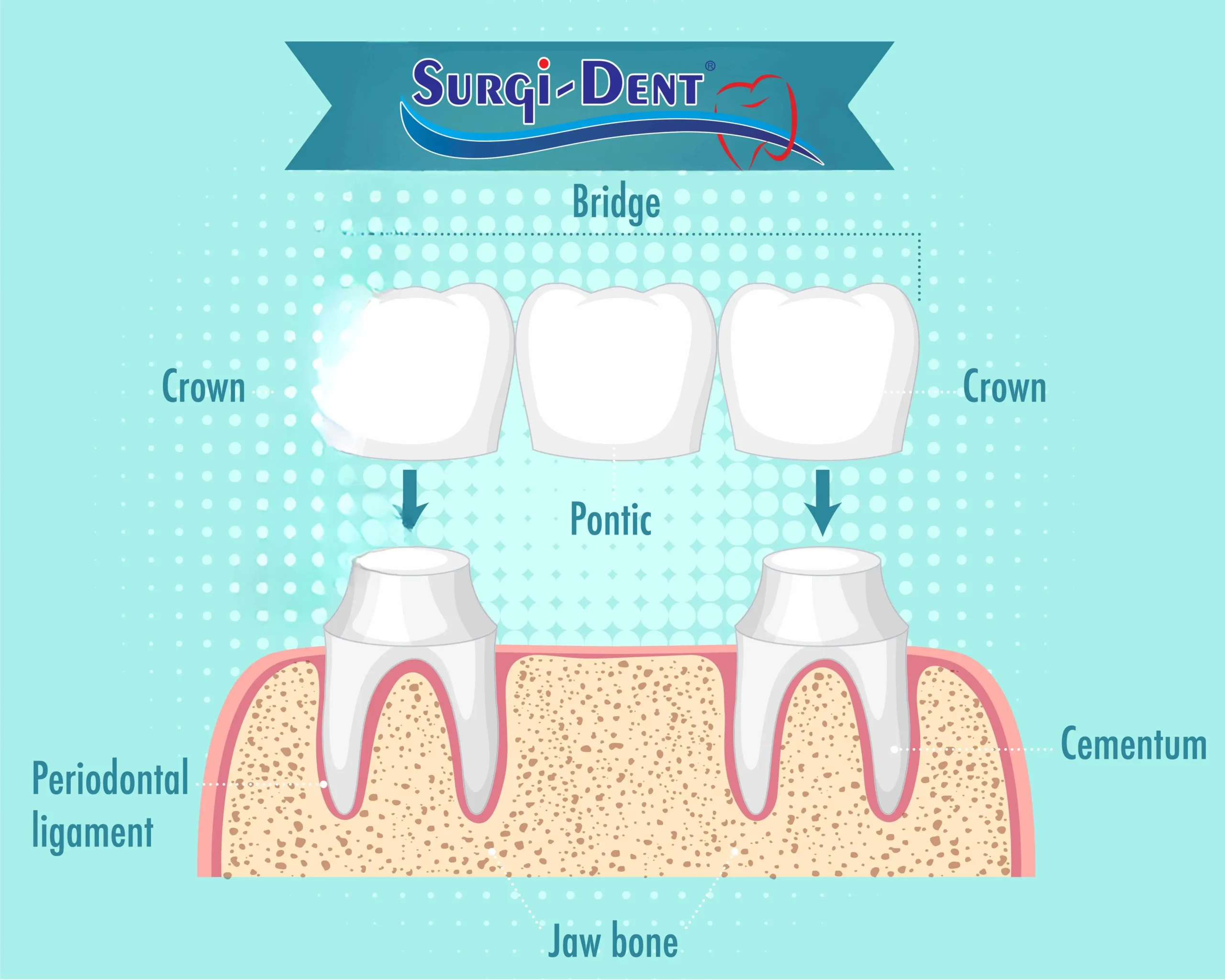 dental bridge components