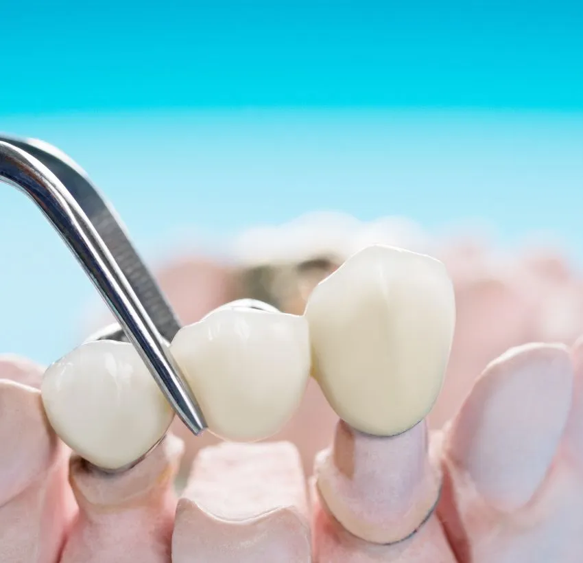 Dental bridges in lahore