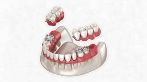 Partial Dentures in Lahore photo