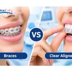 Braces or Clear Aligners: Which Teeth Straightening Option Is Right for You?